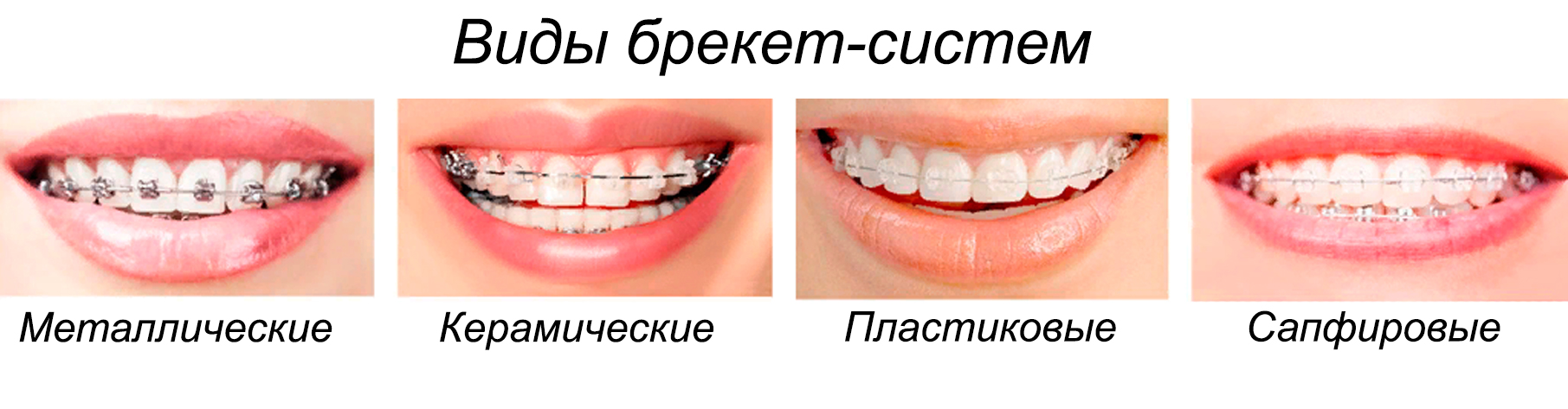 Брекет система презентация